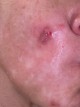 White spots on face that fluctuate