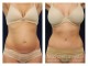 Tummy Tuck Surgery