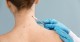 Warts/Skin Tags Treatment in Delhi